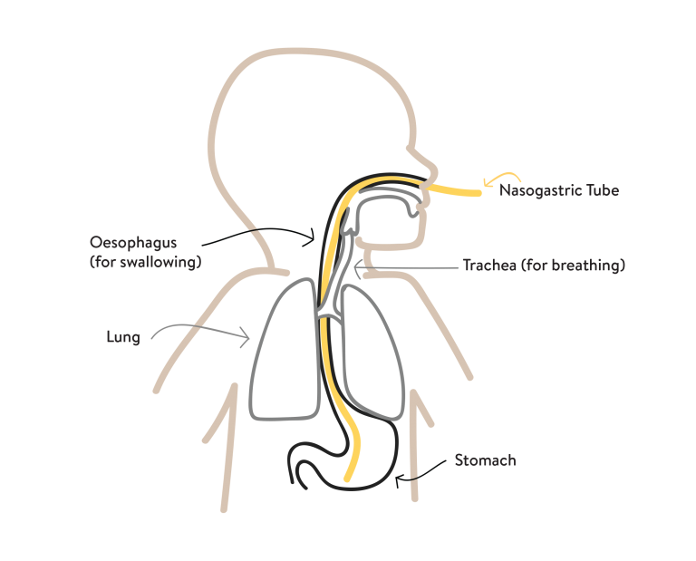 Diet and Feeding Methods The Foundation for Nonketotic Hyperglycinemia